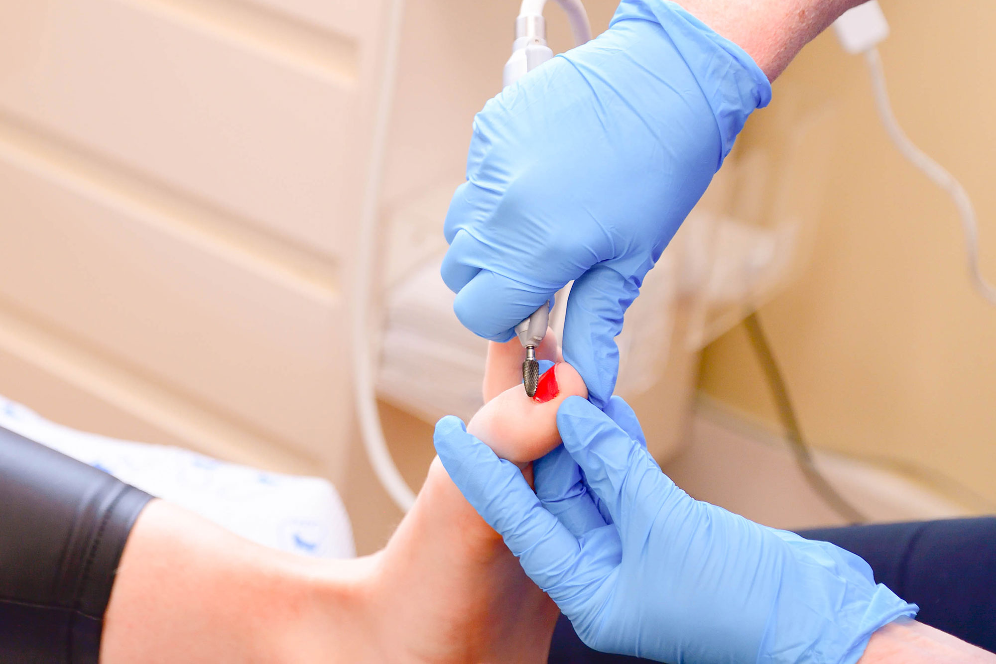 Cardiff and Bridgend Chiropodist Nail trimming